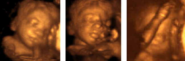 ultraschahl untersuchung in der schwangerschaft